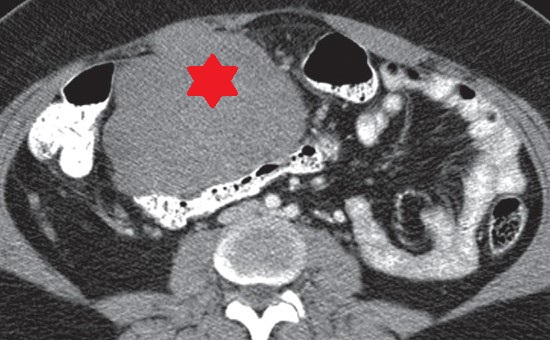 GASTRIC SCHWANNOMA