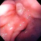 GASTRIC ULCER