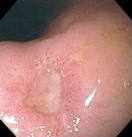 GASTRIC ULCER