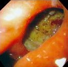 GASTRIC ULCER