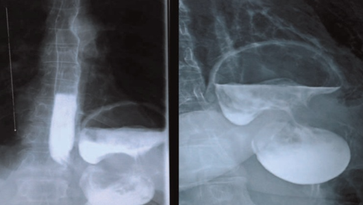 GASTRIC VOLVULUS