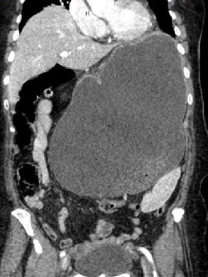 GASTRIC VOLVULUS