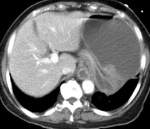 GASTRIC VOLVULUS