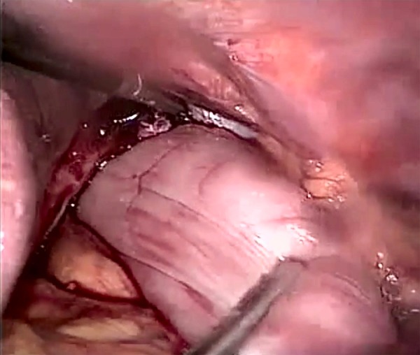 GASTRIC VOLVULUS WITHIN DIAPHRAGMATIC HERNIA.