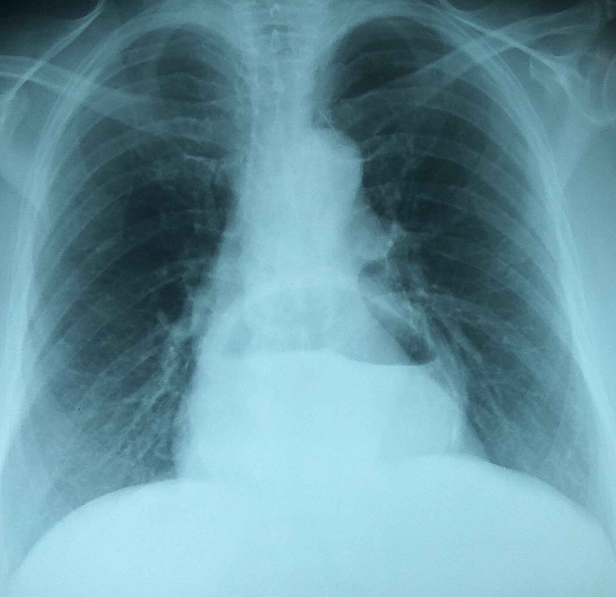 GASTRIC VOLVULUS