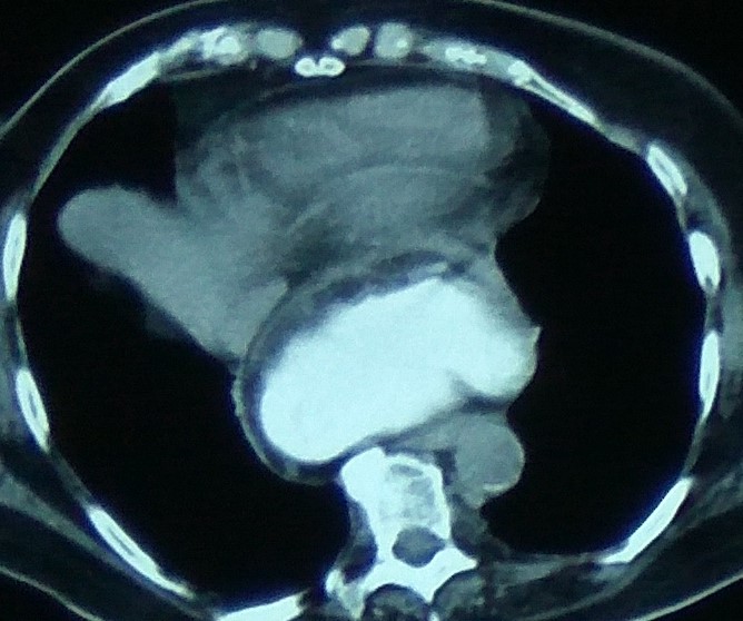 GASTRIC VOLVULUS