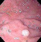 GASTRIC XANTHELASMA
