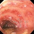 GASTRITIS - BLEEDING