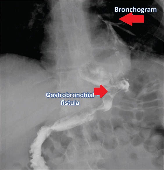 GASTRO-BRONCHIAL FISTULA