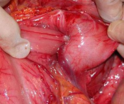 GASTRODUODENAL INTUSSUSCEPTION