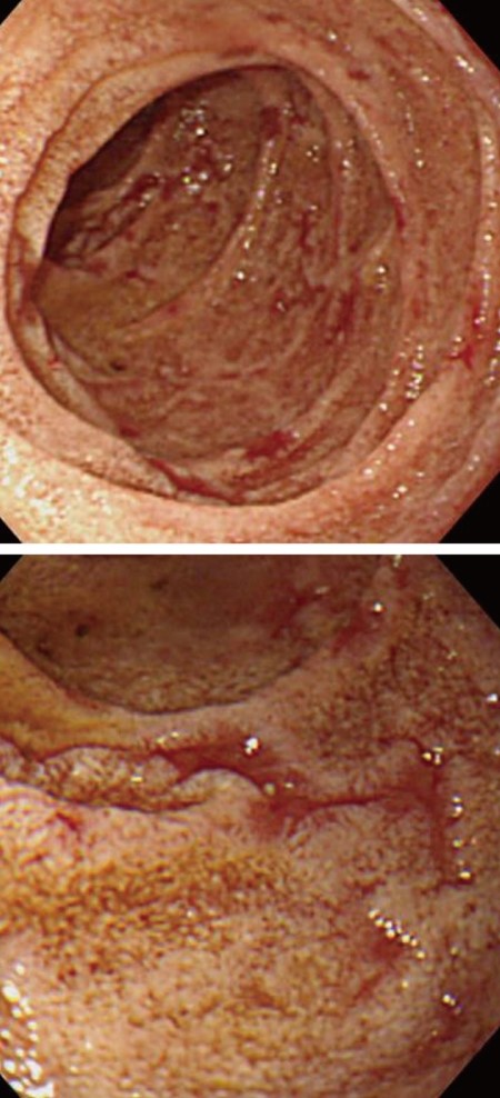 GASTROINTESTINAL AMYLOIDOSIS