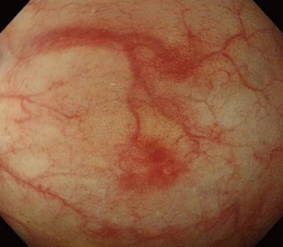 GASTROINTESTINAL AMYLOIDOSIS