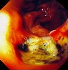 GASTROINTESTINAL SYPHILIS