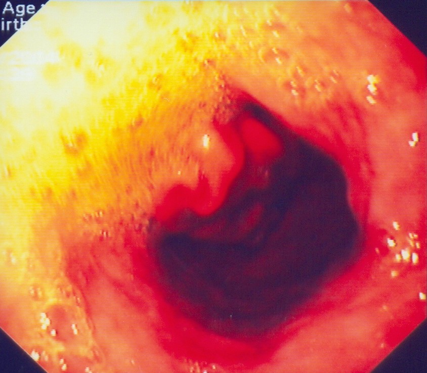 GASTROESOPHAGEAL REFLUX DISEASE