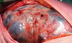 GIANT GASTRIC CYSTIC LYMPHANGIOMA