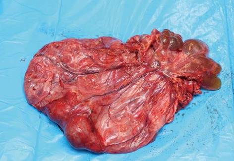 CYSTIC GASTRIC LYMPHANGIOMA