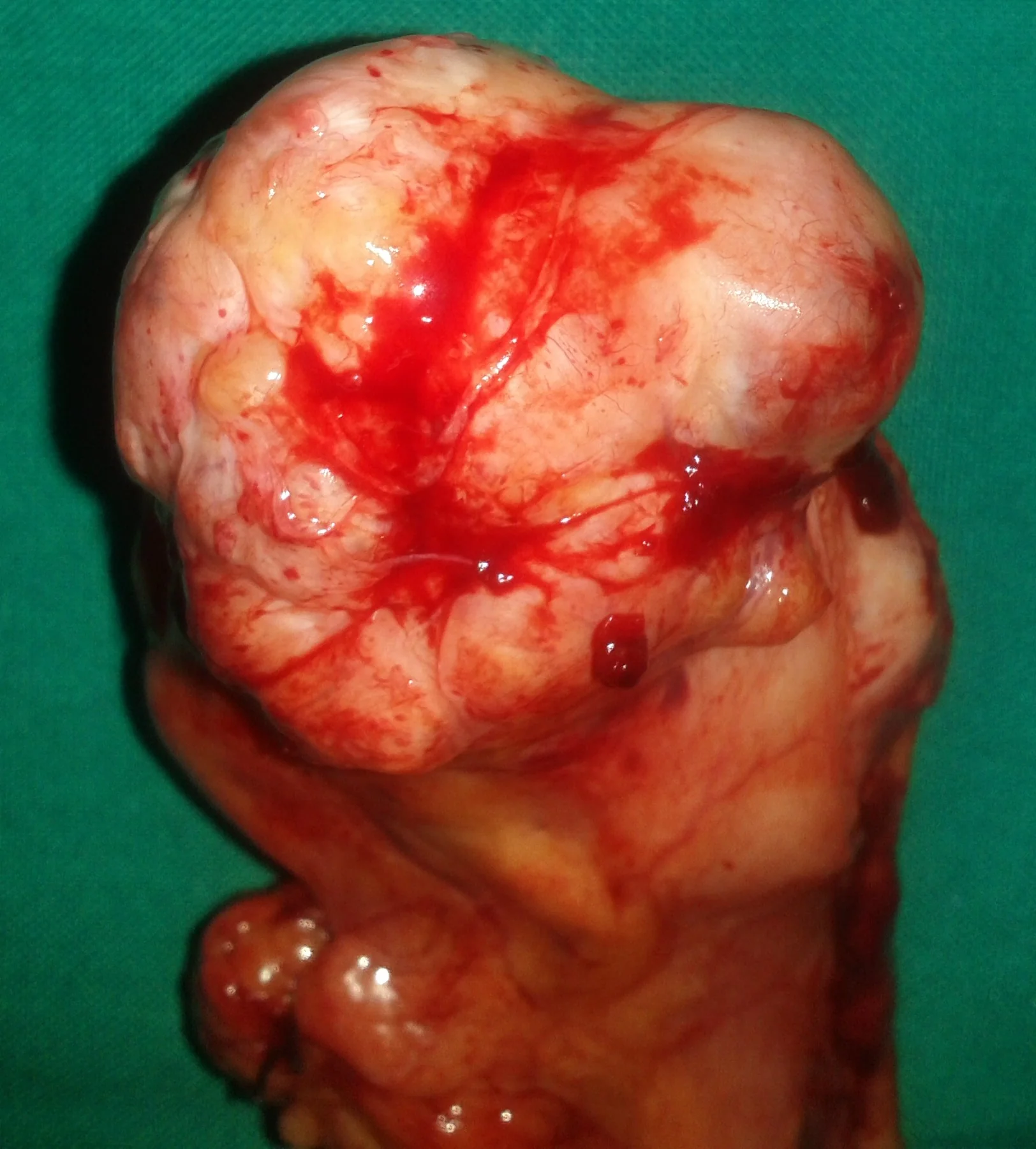 GASTRIC GIST