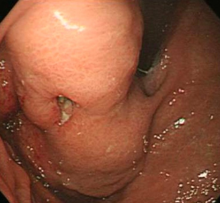 GASTRIC GIST