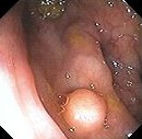 GRANULAR CELL TUMOR