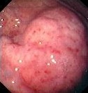 H . PYLORI GASTRITIS