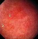 H . PYLORI GASTRITIS