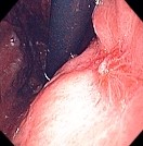 HEALING GASTRIC ULCER