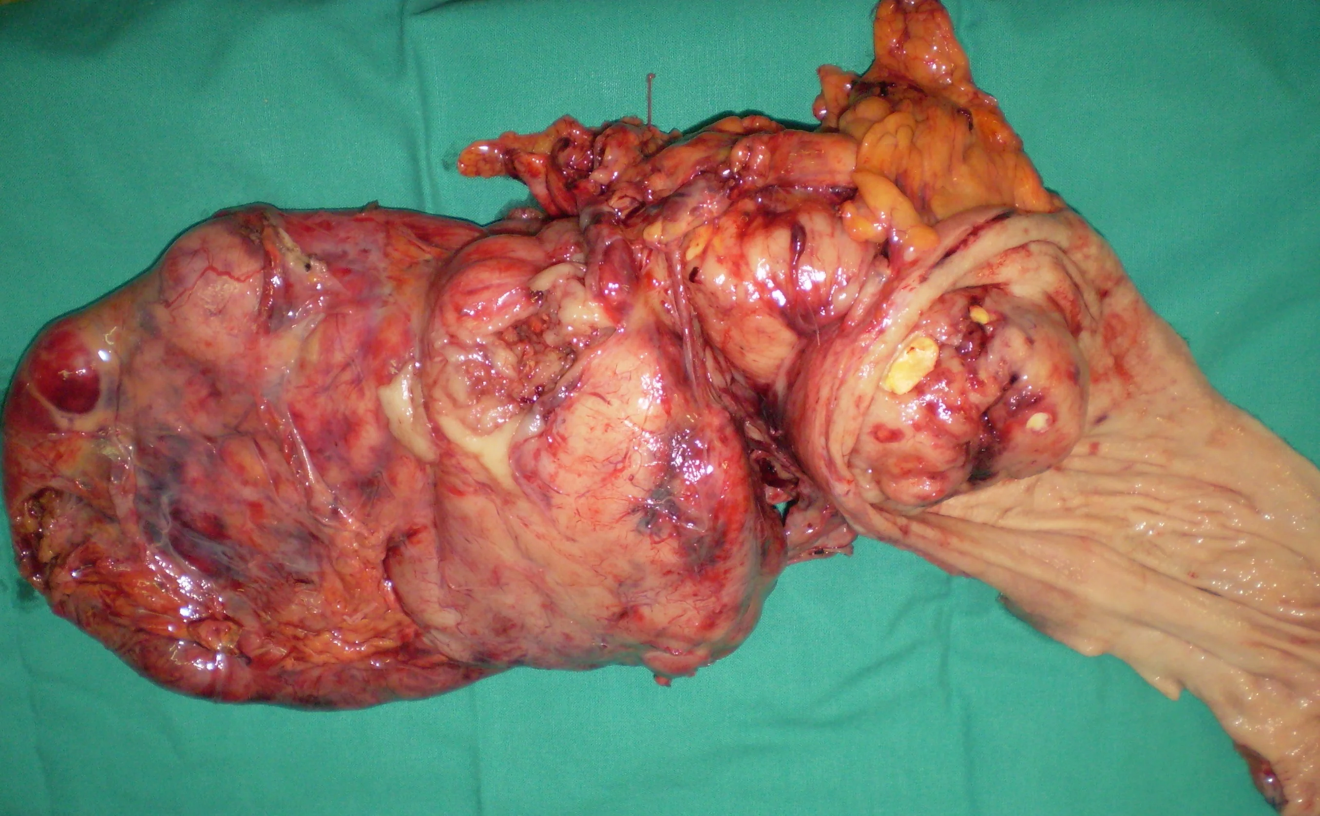GASTRIC GIST