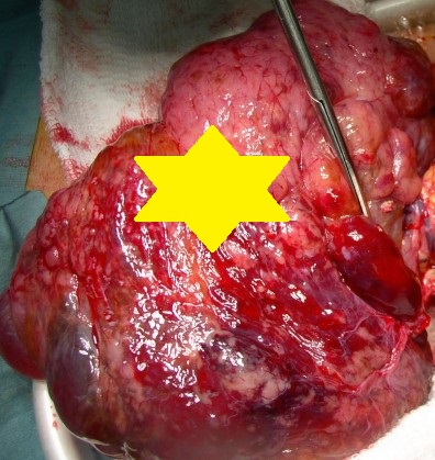 HUGE GASTRIC GIST