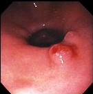 HYPERPLASTIC GASTRIC POLYP
