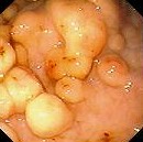 HYPERPLASTIC GASTRIC POLYP