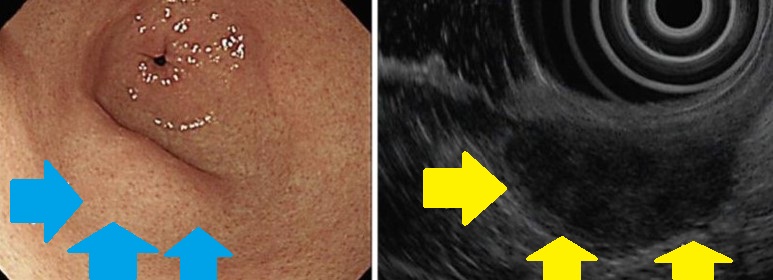 IDIOPATHIC GRANULOMATOUS GASTRITIS