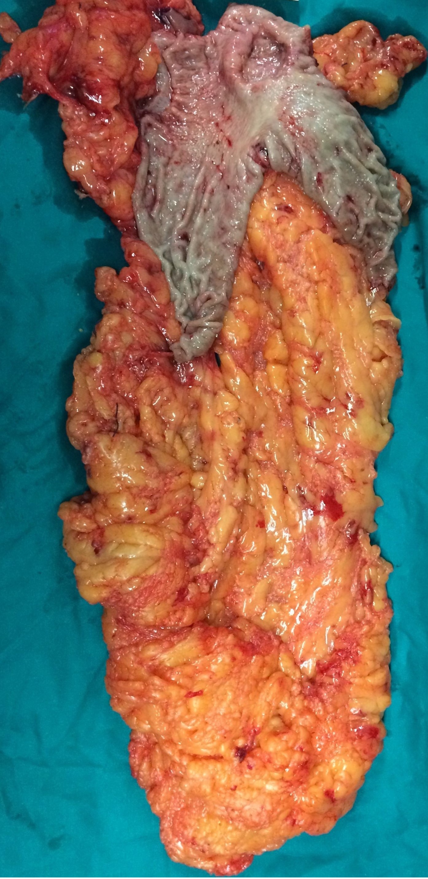 GASTRIC CANCER