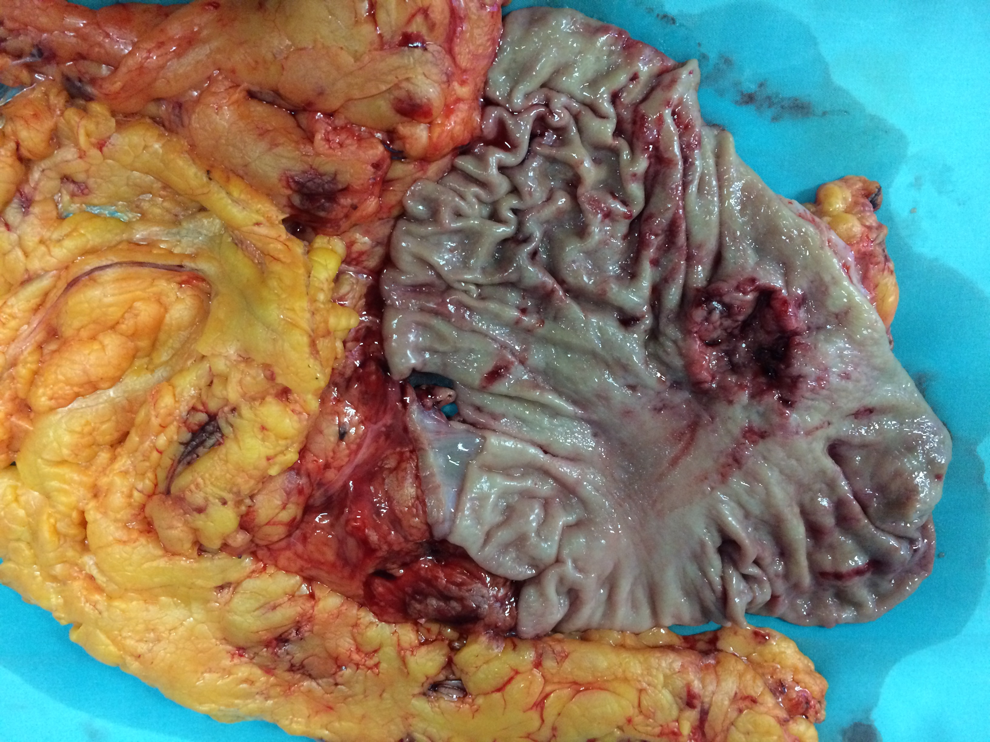 GASTRIC CANCER