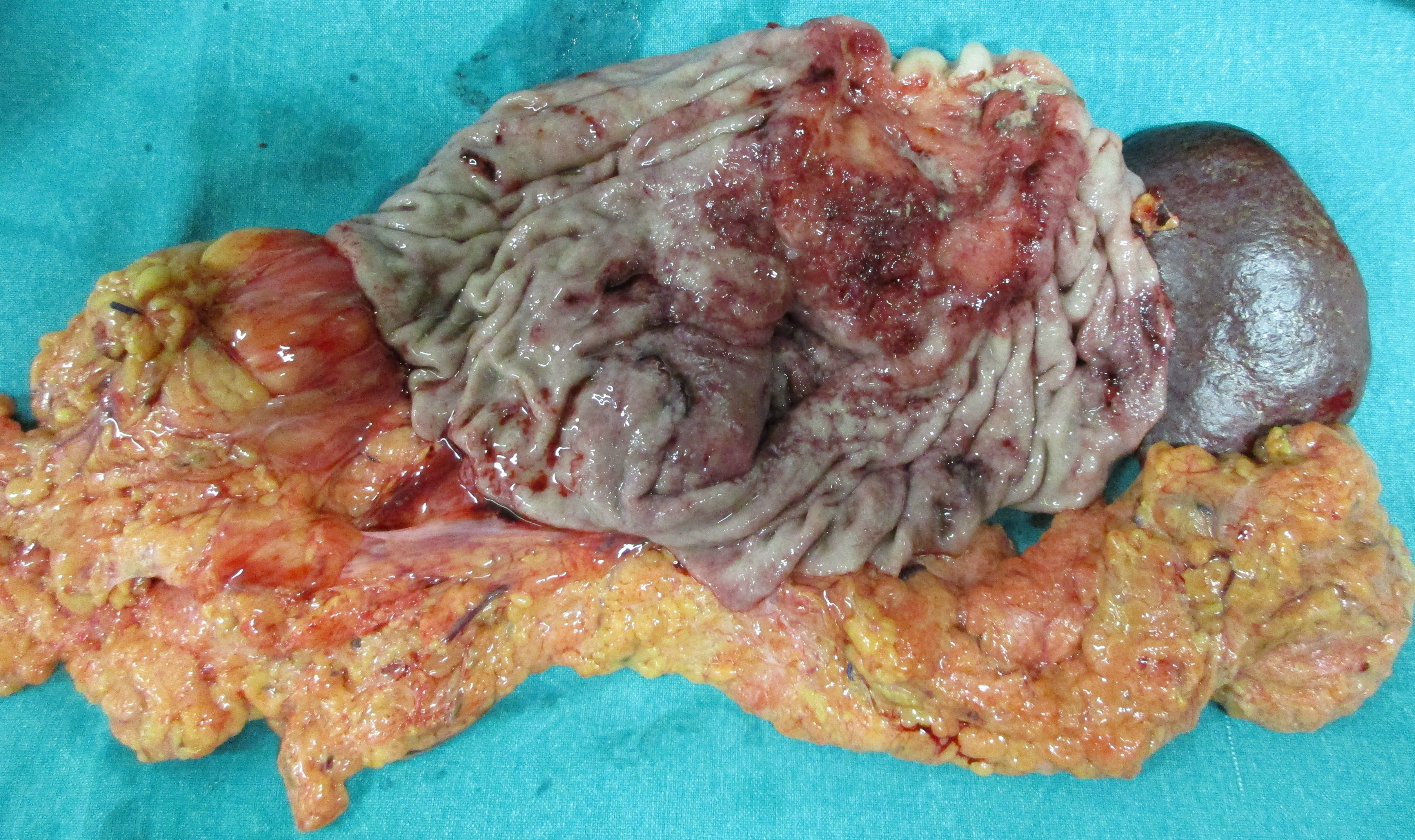 GASTRIC CANCER