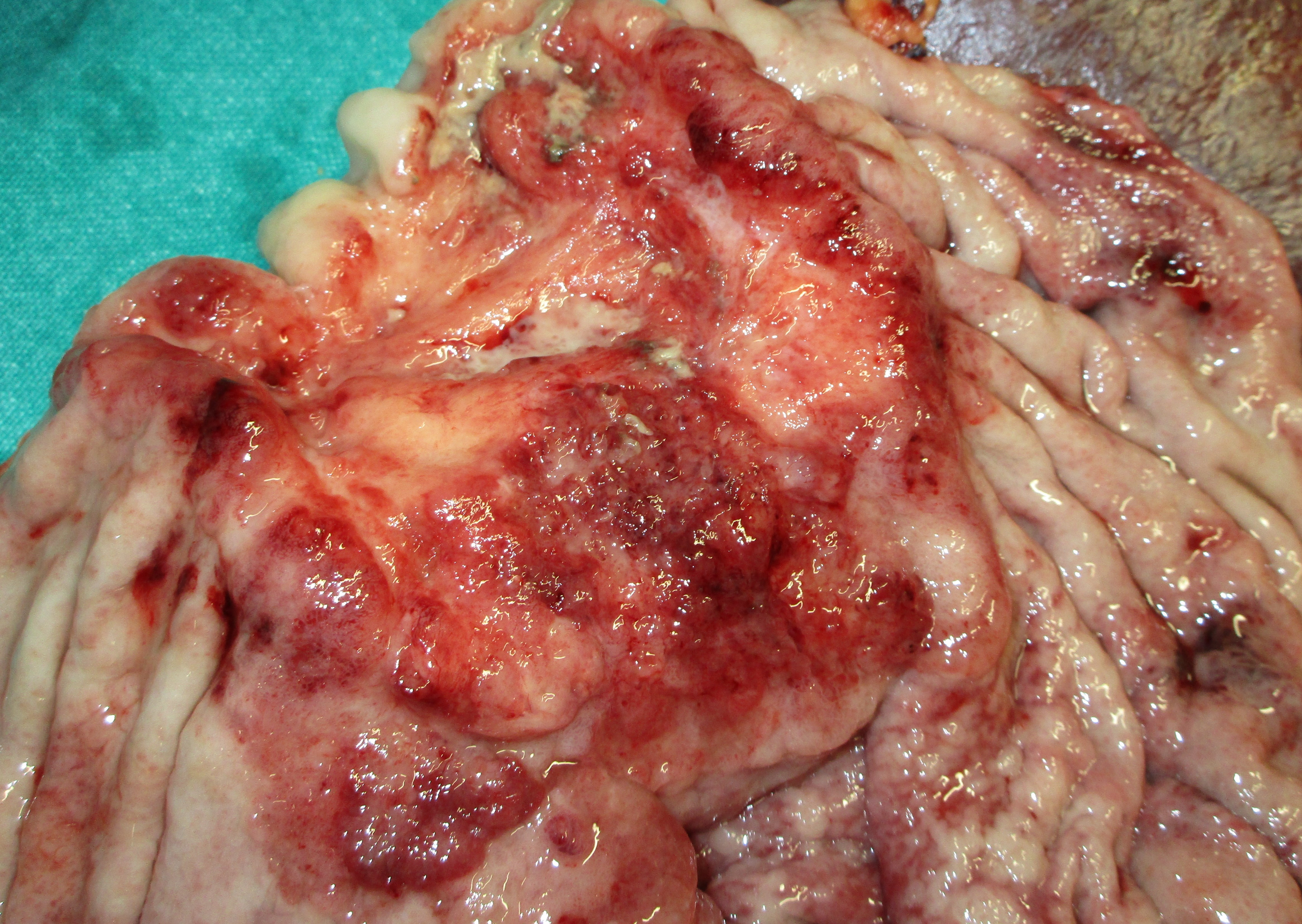 GASTRIC CANCER