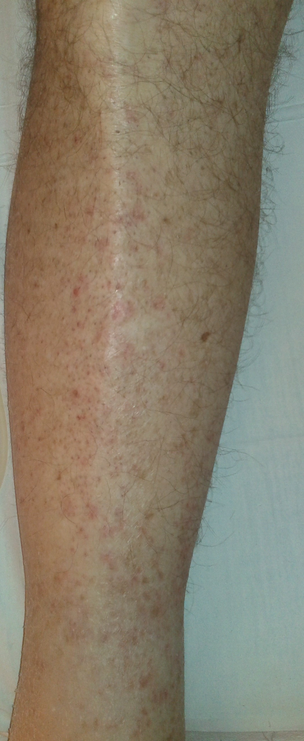 GIST TOXICITY