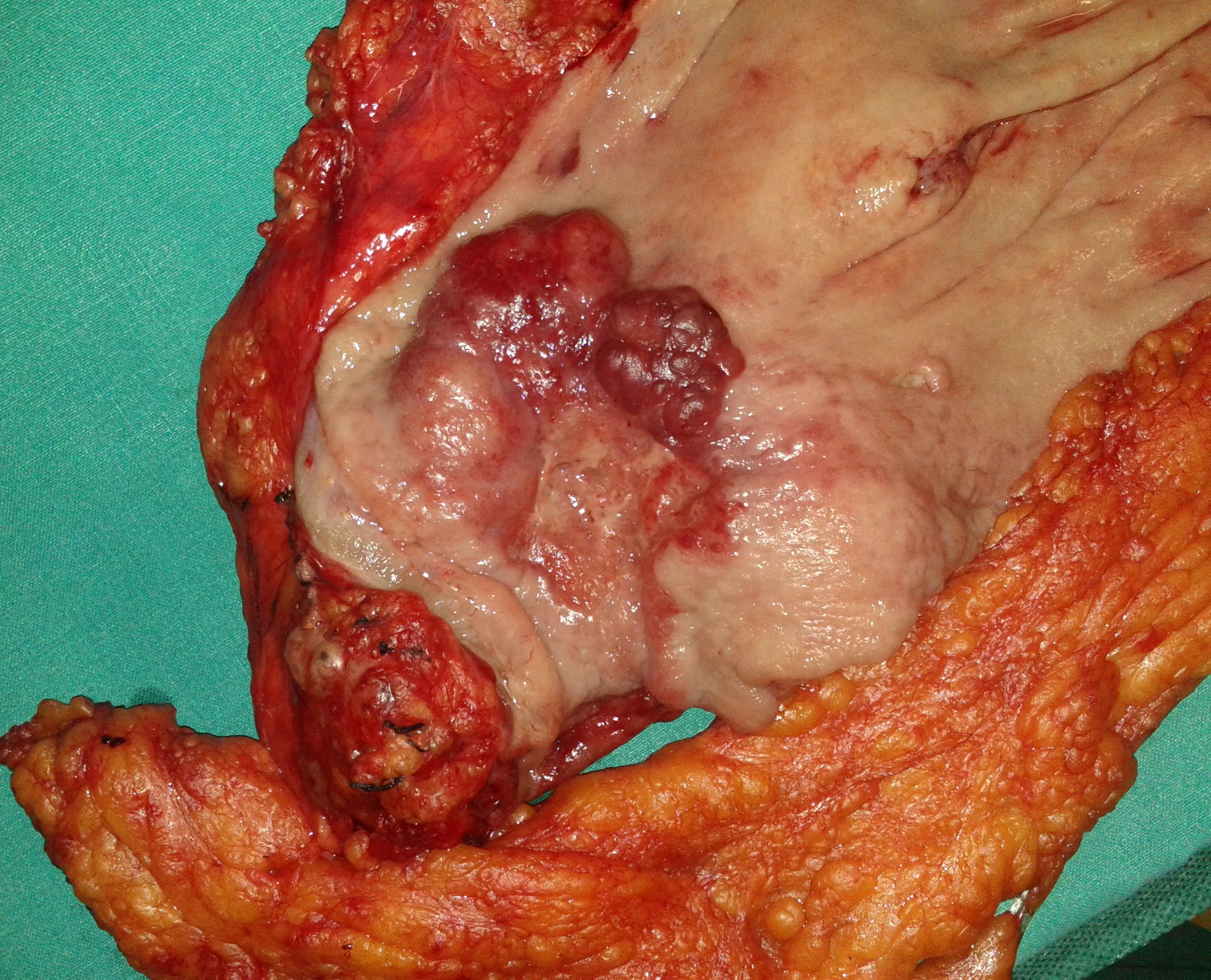 GASTRIC CANCER