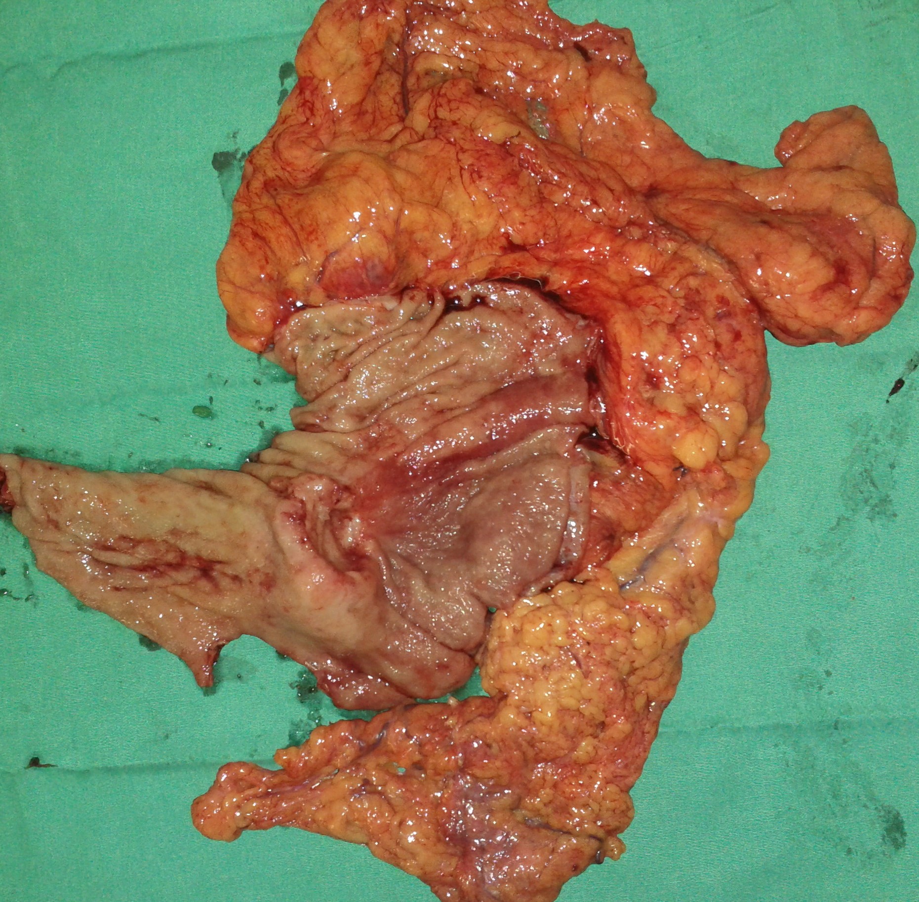 GASTRIC CANCER