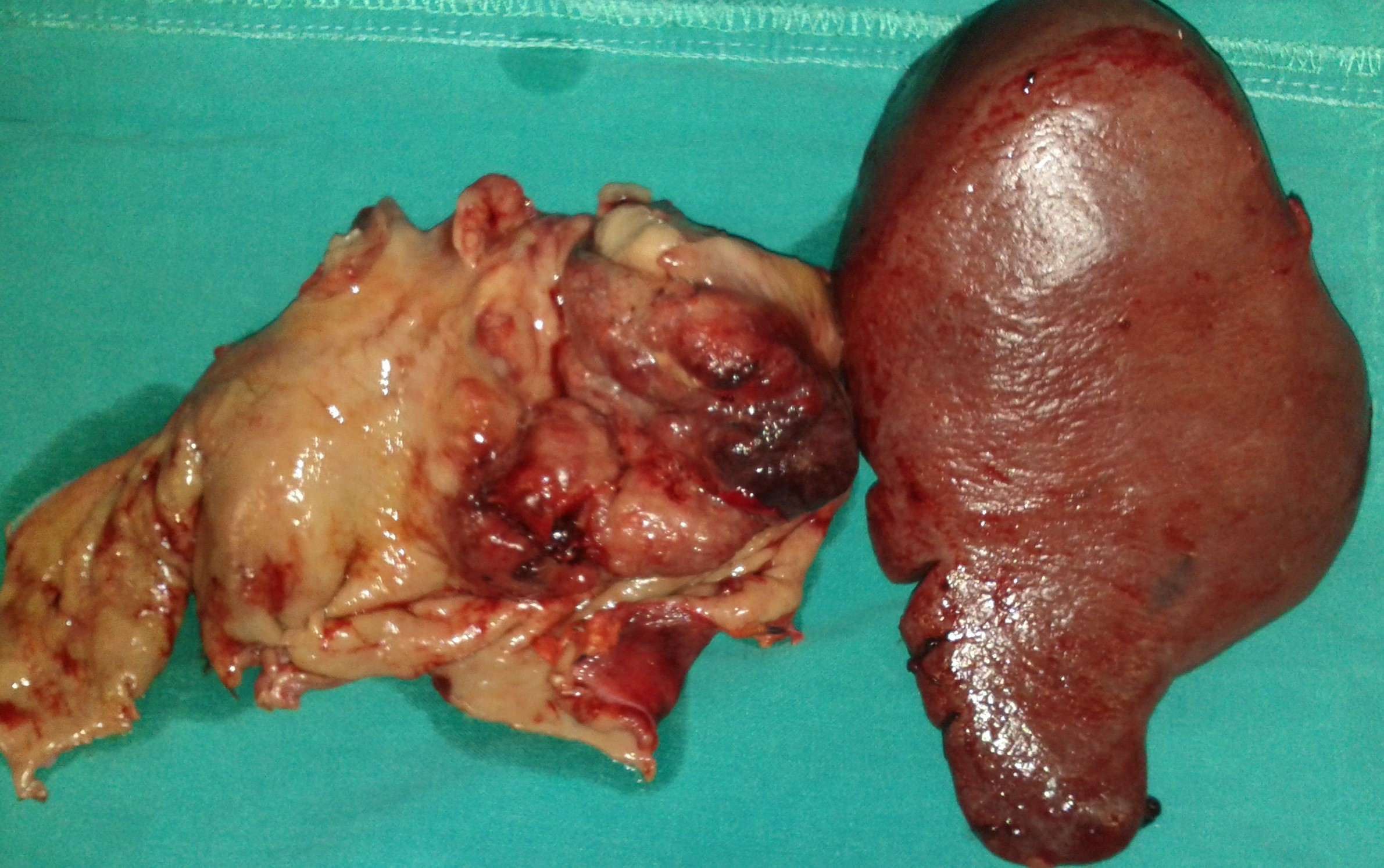 GASTRIC CANCER