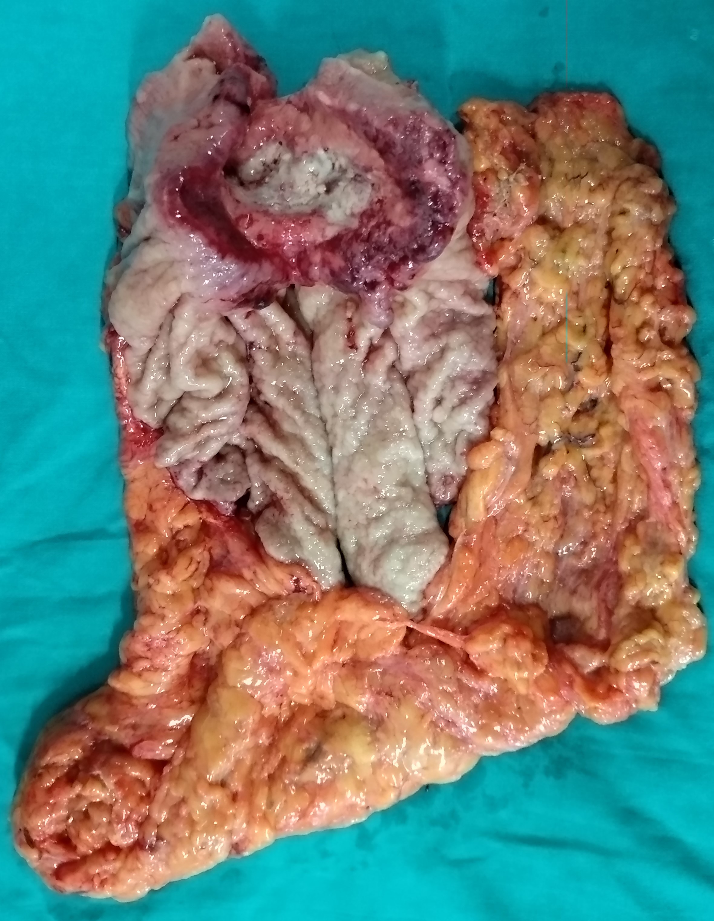 GASTRIC CANCER