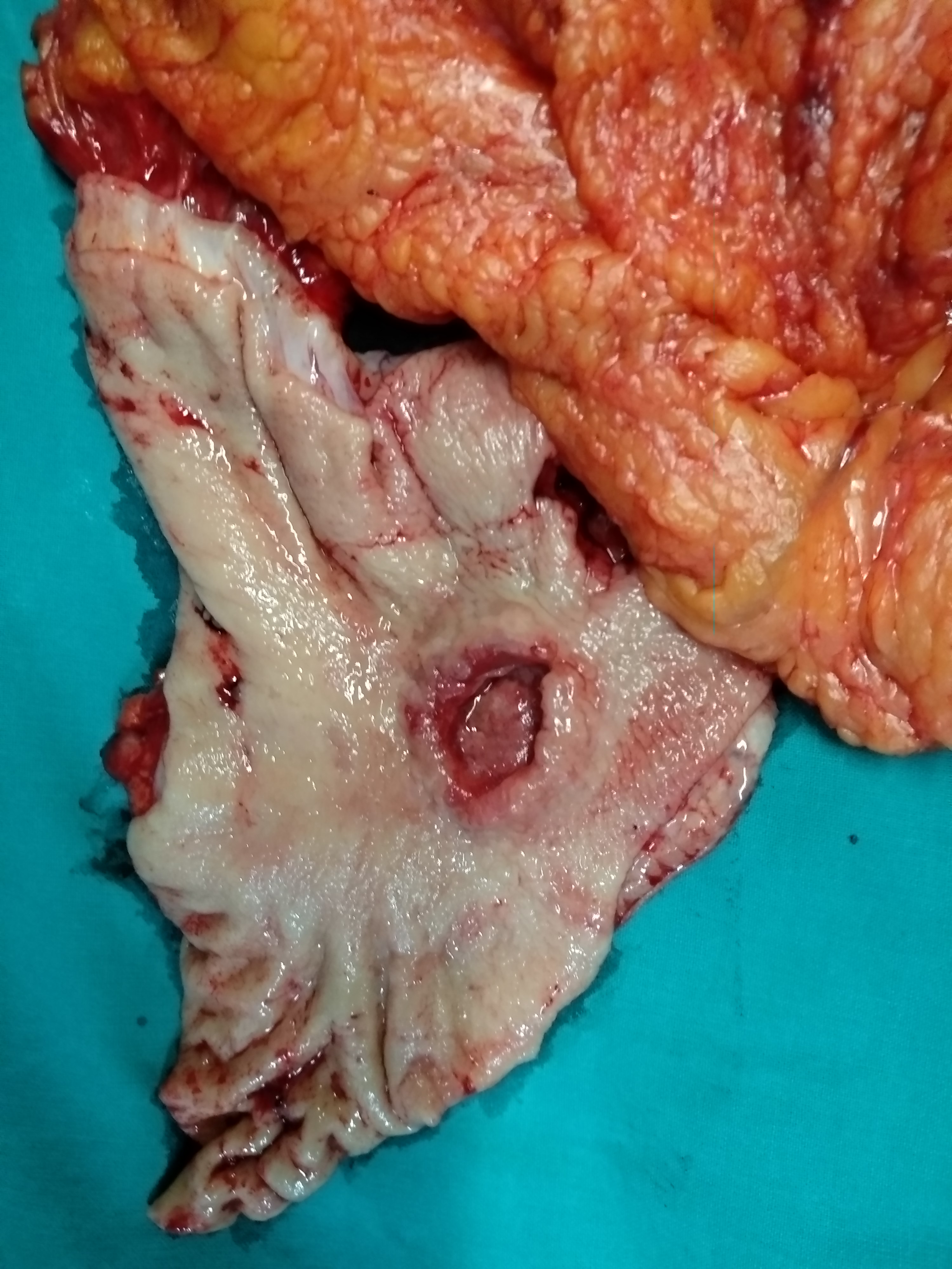GASTRIC CANCER