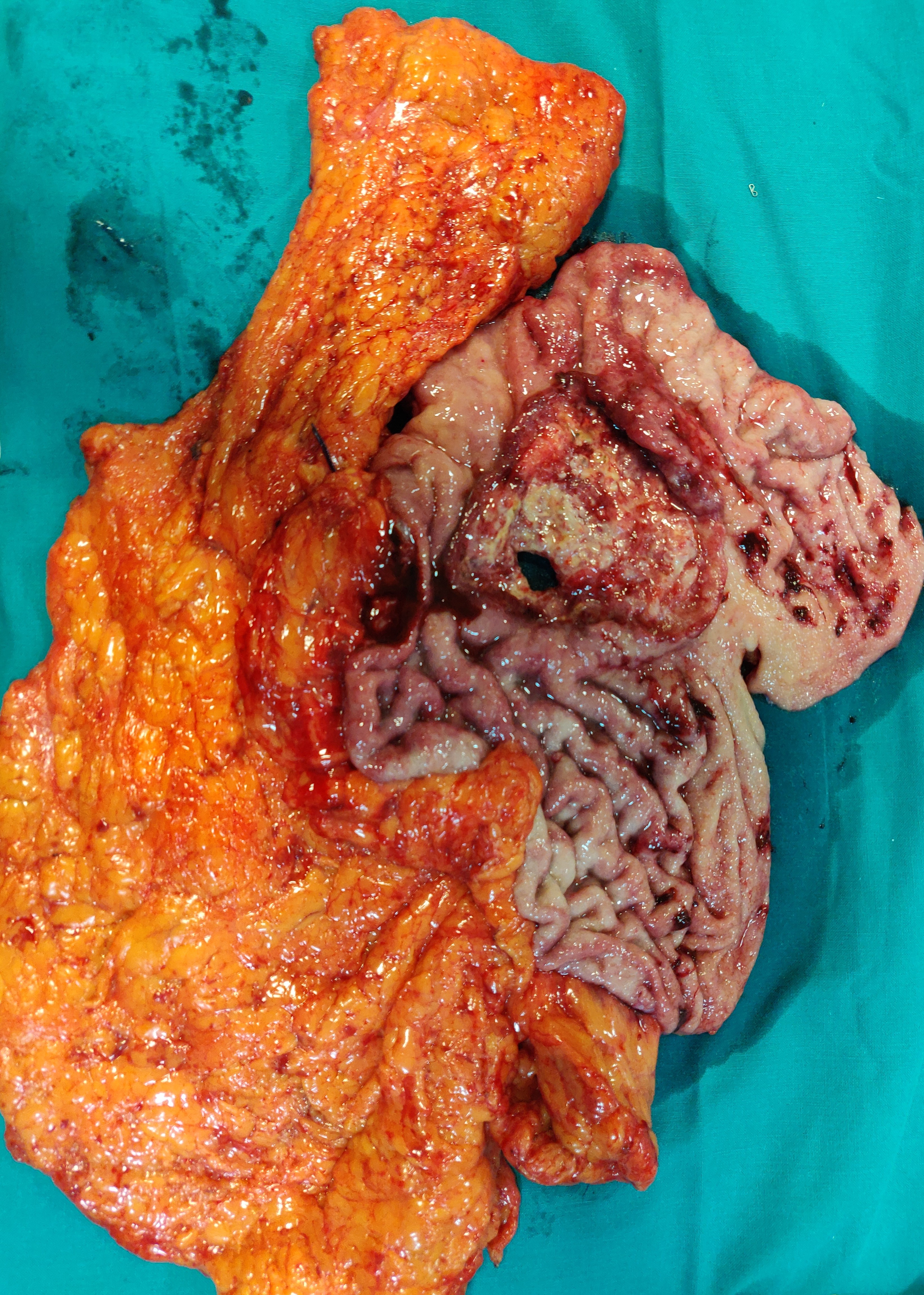 GASTRIC CANCER
