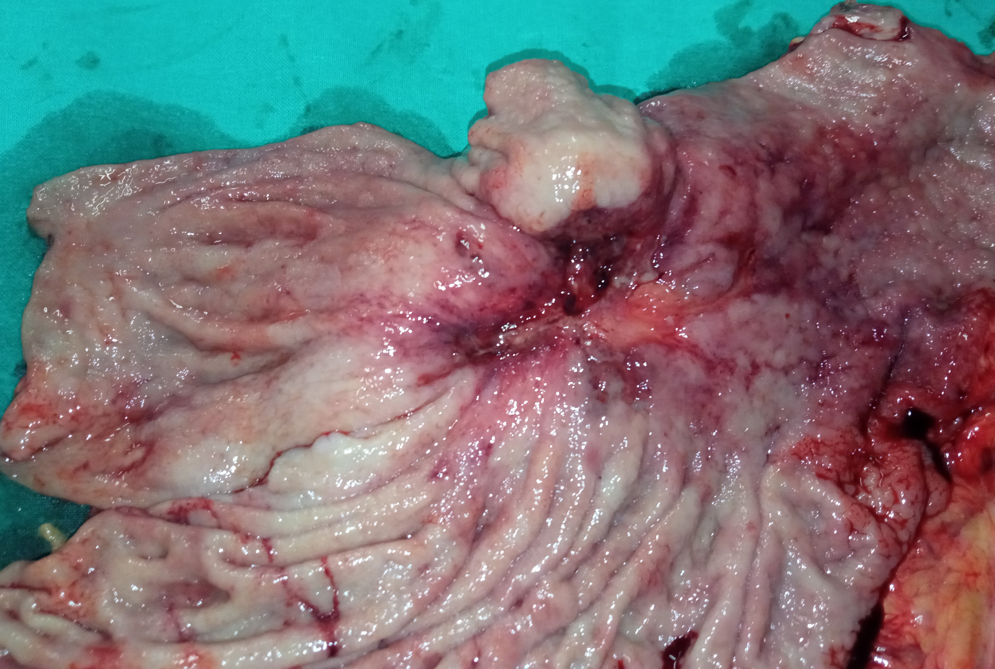 GASTRIC CANCER