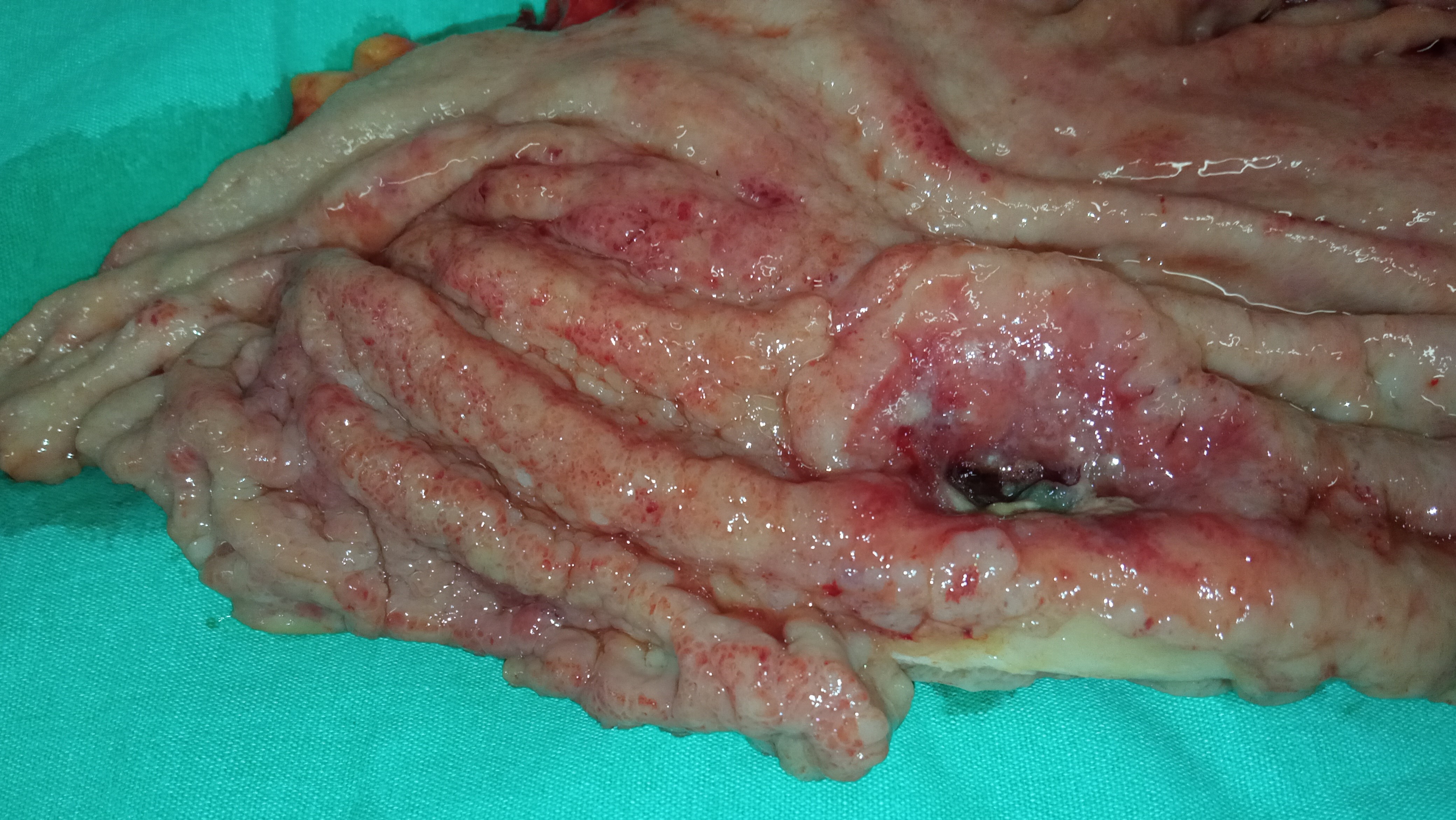 GASTRIC CANCER
