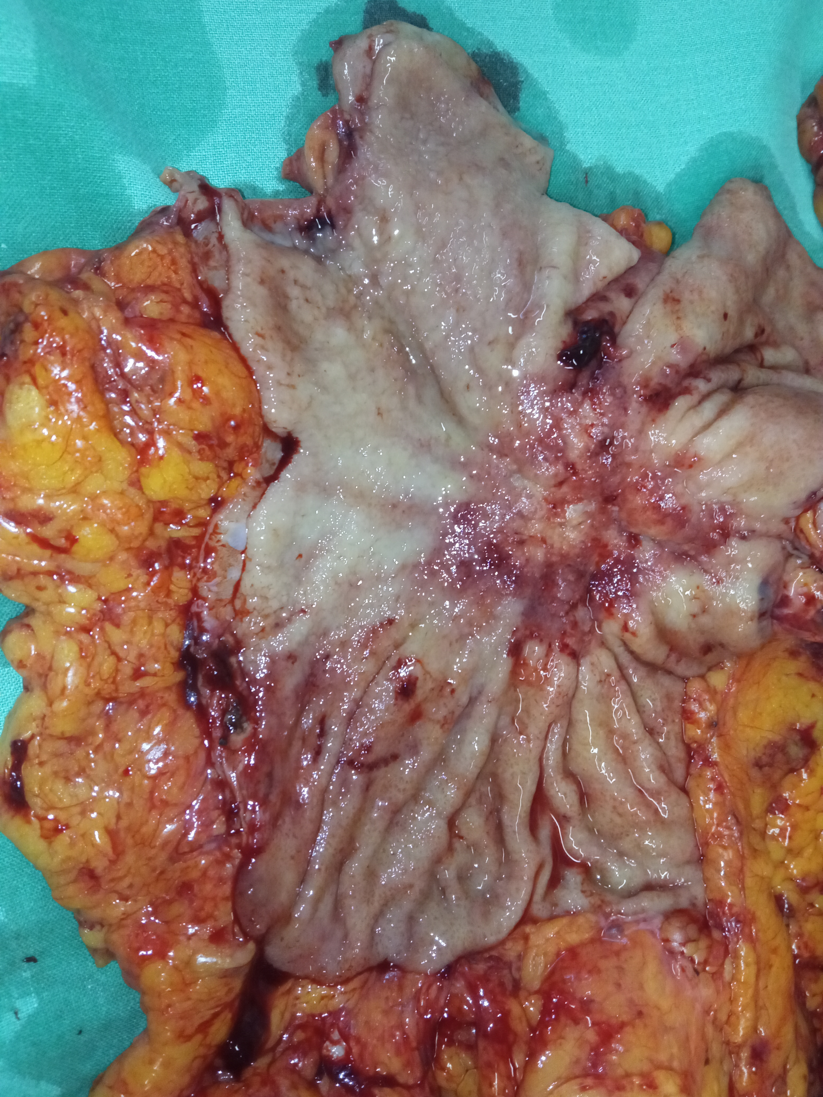 GASTRIC CANCER