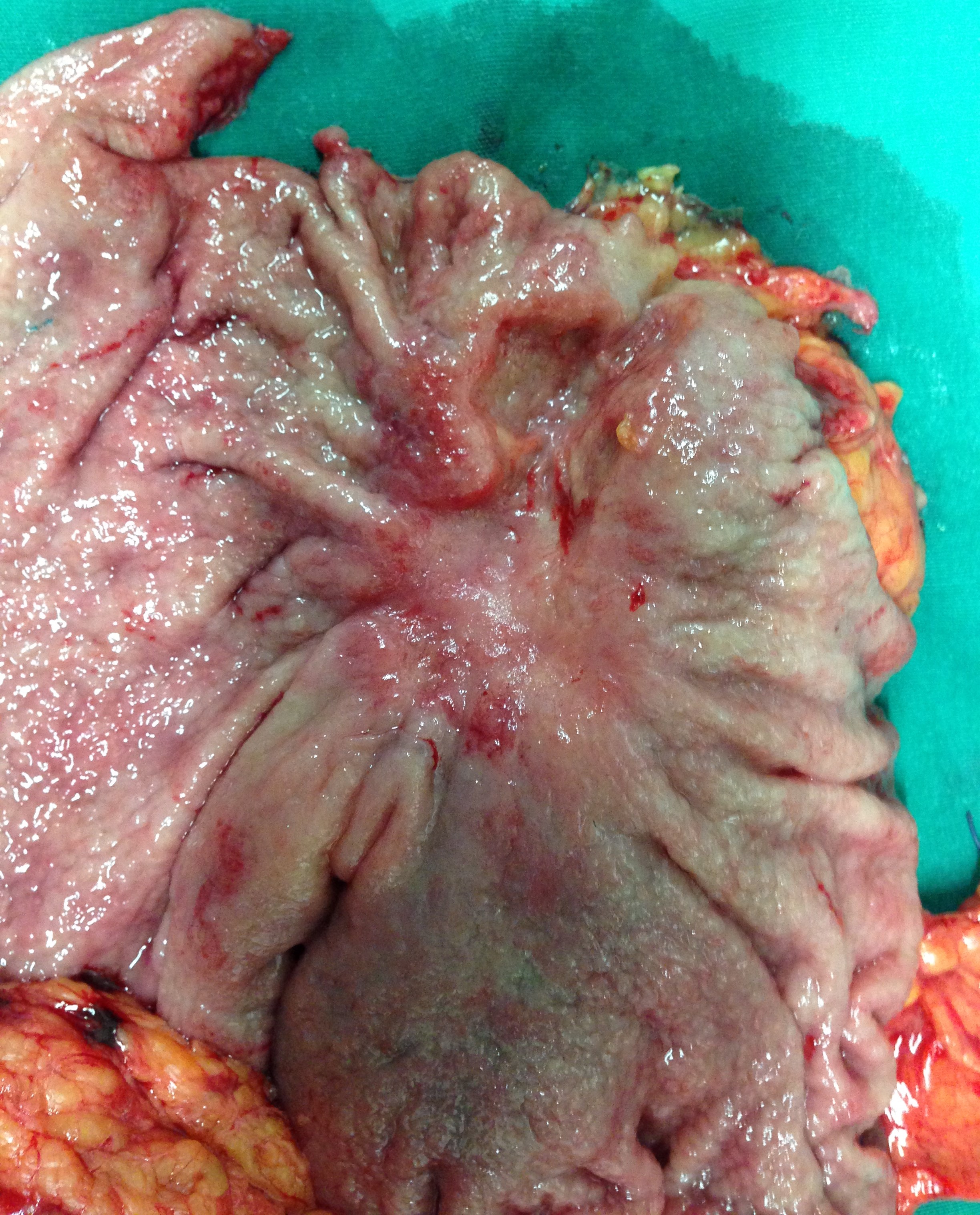 GASTRIC CANCER