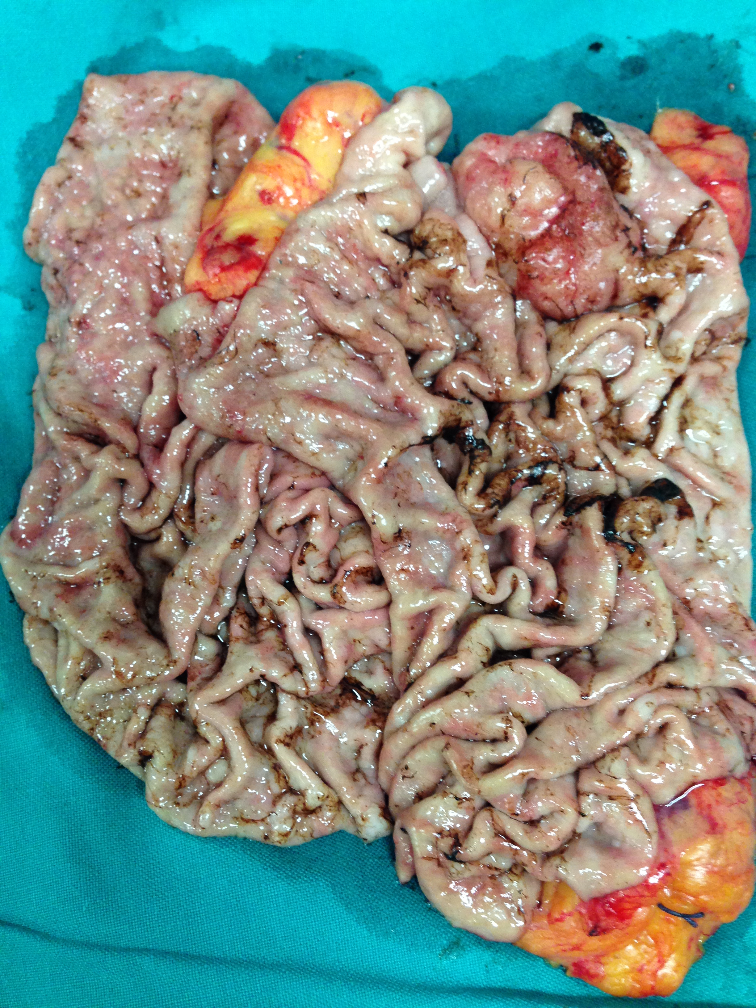 GASTRIC CANCER