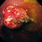INFLAMMATORY GASTRIC POLYP