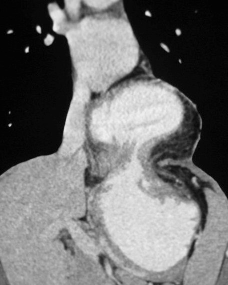 INTRATHORACIC GASTRIC VOLVULUS