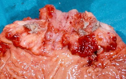 GASTRIC CANCER